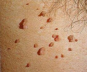 ihmisen papilloomavirus iholla
