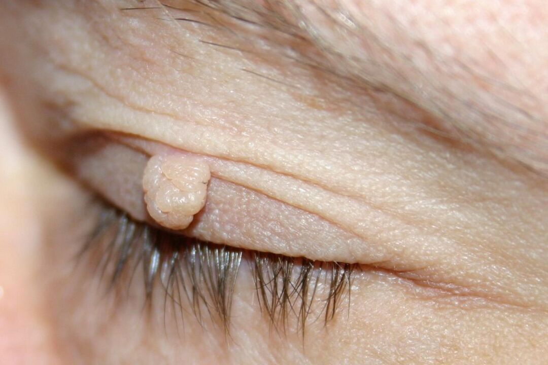 papillooman oireita silmäluomessa